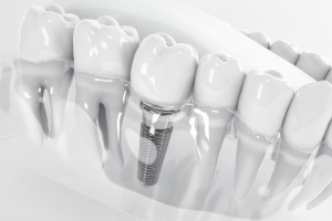 10 Myths Debunked About Single Tooth Implants 10 Myths Debunked About Single Tooth Implants